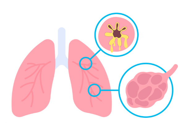 lungs